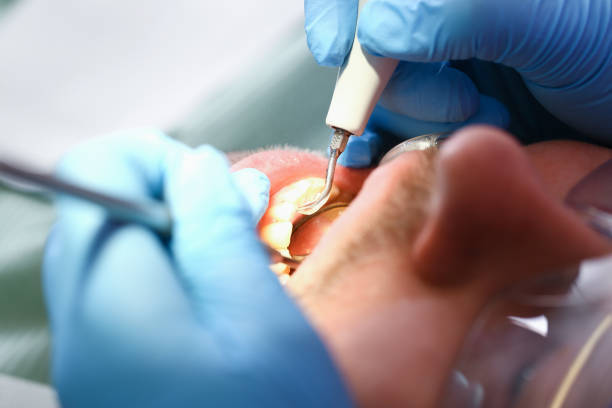 Best Emergency Dentist for Knocked-Out Tooth in Louisiana, MO